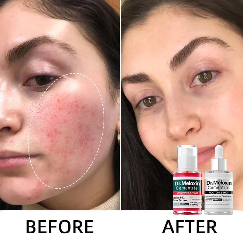 💥Shrinks Pores & Fades Blemish Marks in 2 Weeks | Cyano Pink Spicule Serum+ Picotonic Shot Ampoule