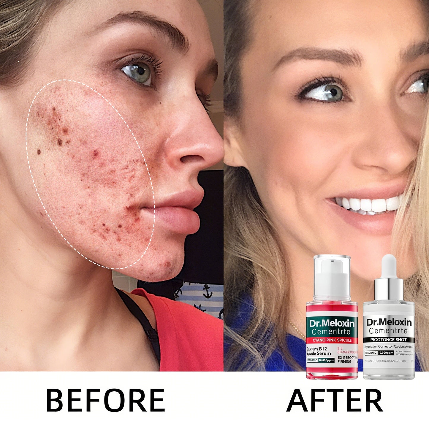 💥Shrinks Pores & Fades Blemish Marks in 2 Weeks | Cyano Pink Spicule Serum+ Picotonic Shot Ampoule