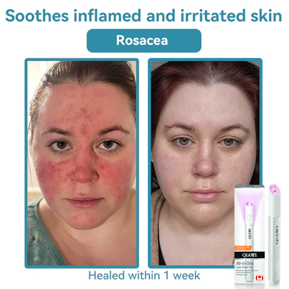 ✨ QIAWI™ CO₂ Laser Pen | Professional-Grade Skin Treatment for Moles, Warts, and Dark Spots