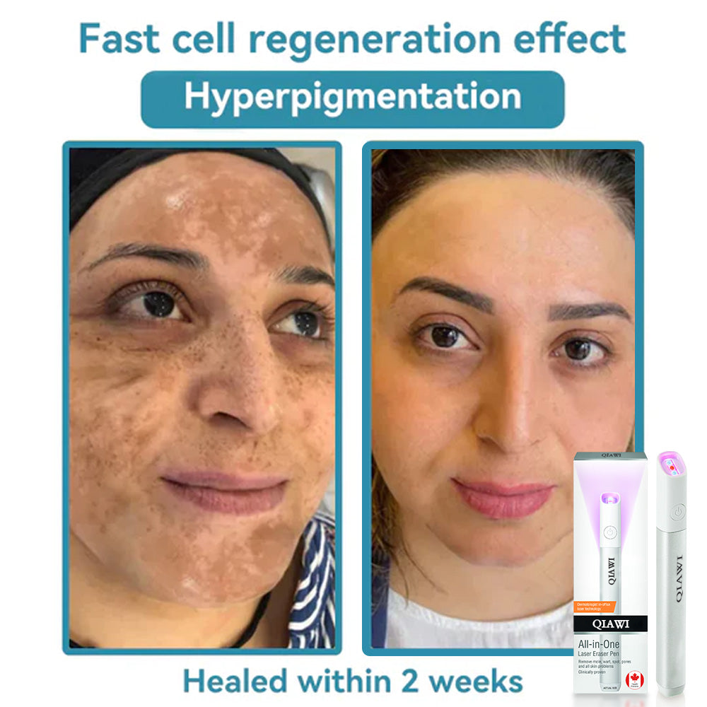 ✨ QIAWI™ CO₂ Laser Pen | Professional-Grade Skin Treatment for Moles, Warts, and Dark Spots