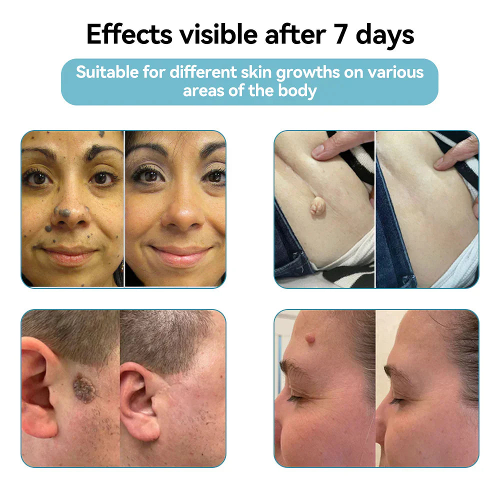✨ QIAWI™ CO₂ Laser Pen | Professional-Grade Skin Treatment for Moles, Warts, and Dark Spots