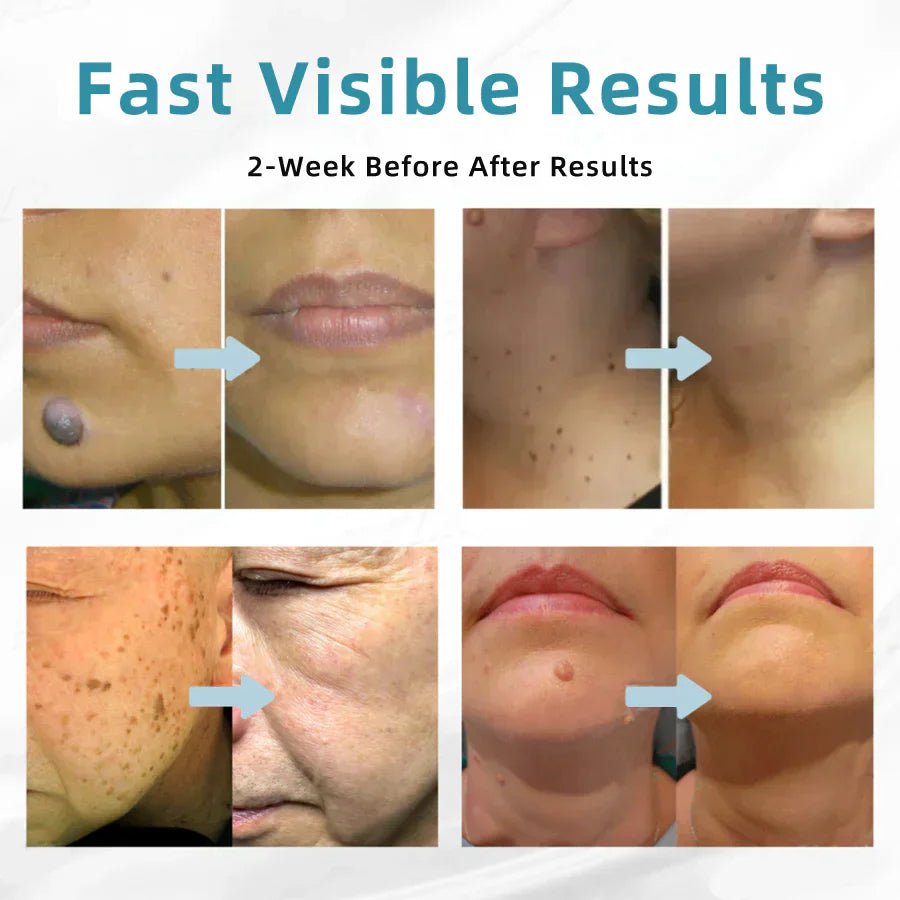 ✨ QIAWI™ CO₂ Laser Pen | Professional-Grade Skin Treatment for Moles, Warts, and Dark Spots