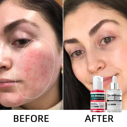 💥Shrinks Pores & Fades Blemish Marks in 2 Weeks | Cyano Pink Spicule Serum+ Picotonic Shot Ampoule