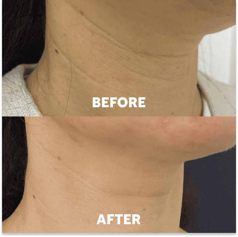 Proserendipity™ Neck Masks