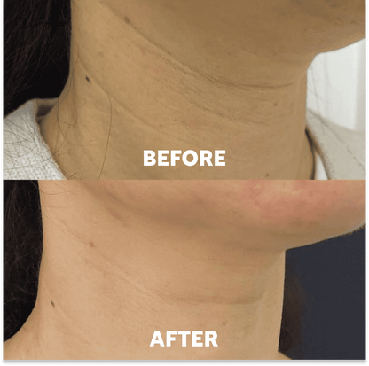 Proserendipity™ Neck Masks