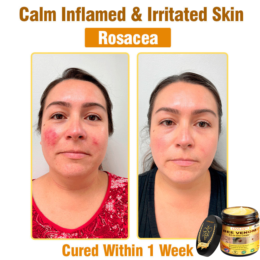 LOVILDS™ 𝘽𝙀𝙀 𝙑𝙀𝙉𝙊𝙈 𝑺𝒌𝒊𝒏 𝑹𝒆𝒔𝒕𝒐𝒓𝒂𝒕𝒊𝒐𝒏 𝑪𝒓𝒆𝒂𝒎 –🌸 Anti-Aging, Hydrating & Skin Repair