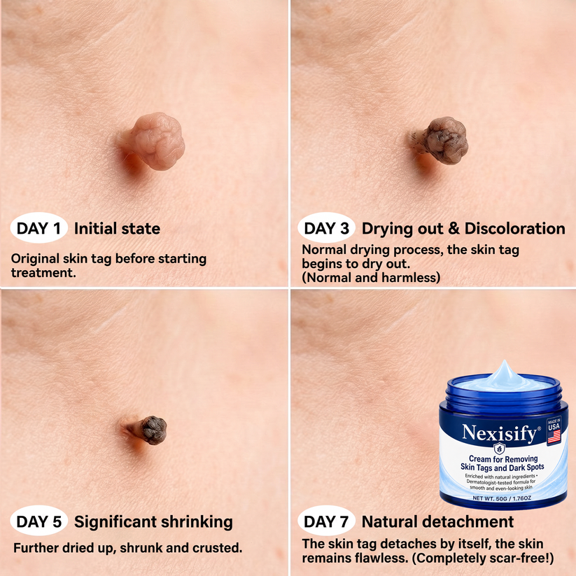 Nexisify® Advanced Correcting Cream for Skin Tags, Moles & Spots – 7‑Day Painless & Scar‑Free – Advanced Care for Skin Imperfections