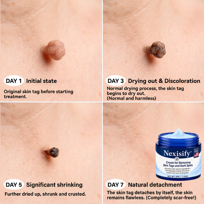 Nexisify® Advanced Correcting Cream for Skin Tags, Moles & Spots – 7‑Day Painless & Scar‑Free – Advanced Care for Skin Imperfections